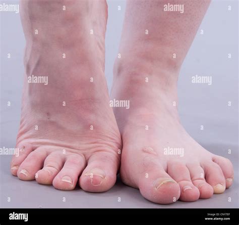 Ugly Feet Stock Photos, Images & Pictures